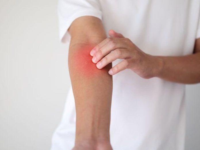 skin-issues-can-be-fir.jpg