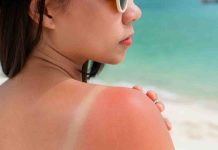 How you can keep away from sunburn? Strive these 5 tricks to stop them
