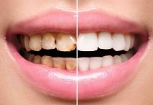 5 easy methods to eliminate tartar from tooth at residence