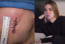 Khloe Kardashian places pores and skin most cancers again in highlight: Know in regards to the situation