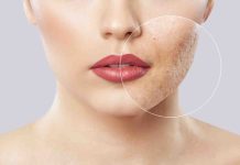 The way to eliminate pimples scars? Listed here are therapy choices