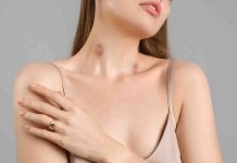 Residence cures for hickeys: Know what works and what would not?