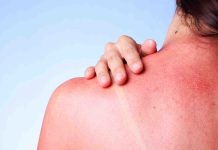 Skincare suggestions: 5 issues to keep away from whereas treating a sunburn