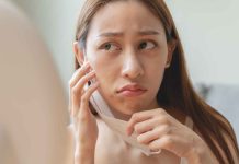 Are you able to get pimples from kissing?