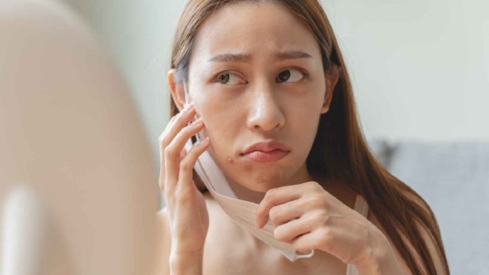 acne-5.jpg