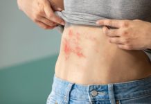 Shingles: Signs, causes, issues and therapy