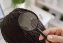 Dandruff: What’s it, Causes, Remedy and Prevention Ideas