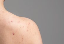 Shoulder zits: Causes and residential cures