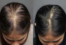 Is alopecia the identical as hair loss? Know the distinction