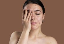Learn how to do away with a boil: Therapy and aftercare suggestions