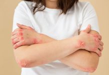 Crimson spots on pores and skin: Know the causes and therapy