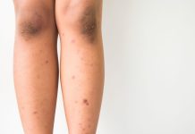 Darkish spots on legs: Why does this occur and methods to deal with them
