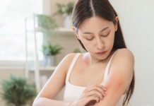 Caterpillar rash: Signs and therapy