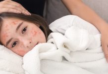 Measles outbreak: Know whether it is related to malnourishment