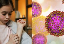 Measles outbreak in USA claims one life: Know signs and find out how to stop it