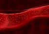 Haemophilia: Signs, prognosis, and efficient administration