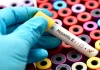 Hepatitis B: Why early detection issues?