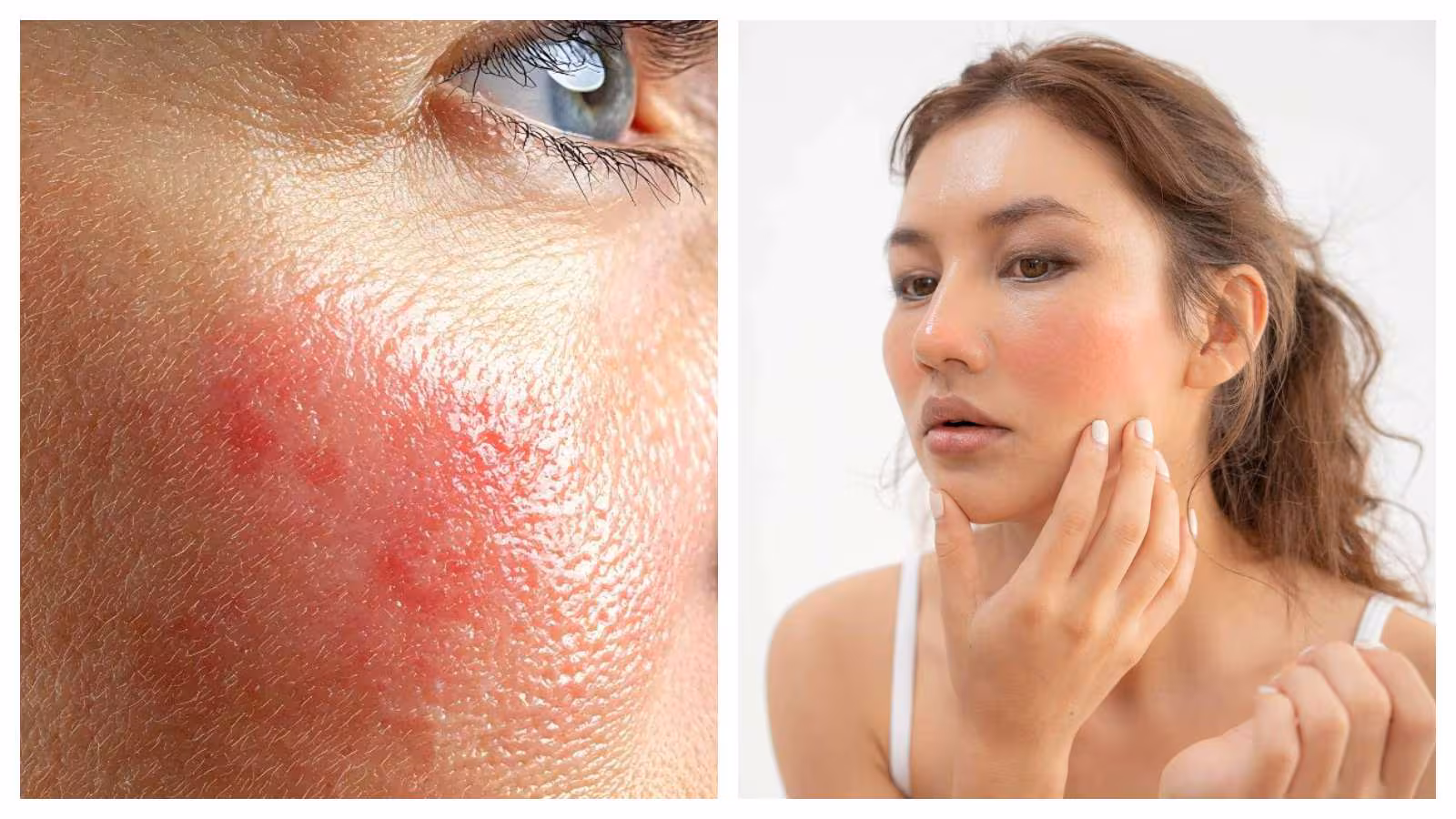 Pores and skin allergic reactions: Why they return and find out how to restore your pores and skin barrier