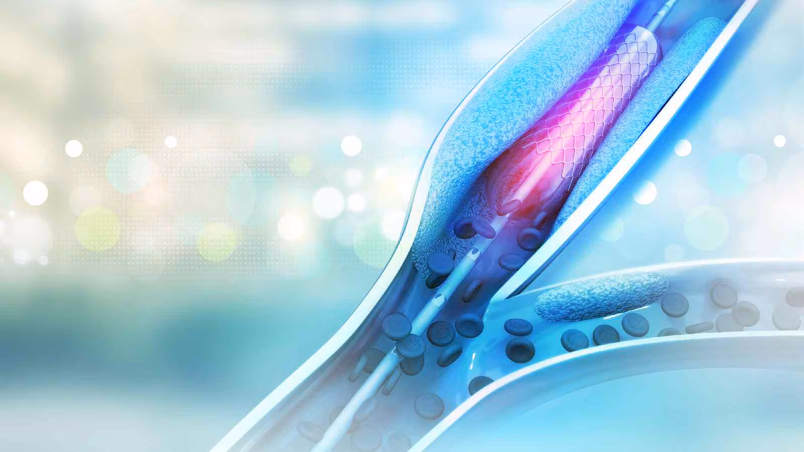 Radial vs femoral angioplasty: The benefit of the wrist strategy