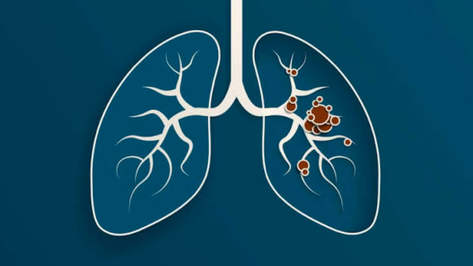 Genetic testing’s function in lung most cancers danger and remedy