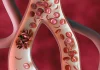 Sickle cell illness: Debunking widespread myths