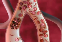 Sickle cell illness: Debunking widespread myths