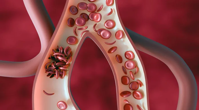 Sickle cell illness: Debunking widespread myths