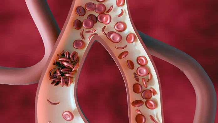sickle-cell-disease.jpg